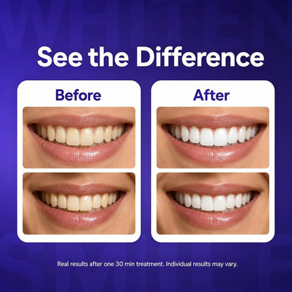 Teeth whitening strips, purple, 14 units